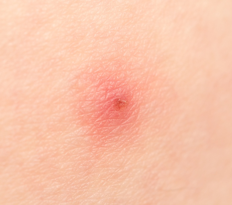 How Do You Treat An Insect Sting While Camping? How Do You Treat An Insect Sting While Camping?