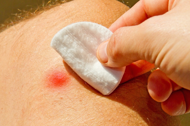 How Do You Treat An Insect Sting While Camping? How Do You Treat An Insect Sting While Camping?