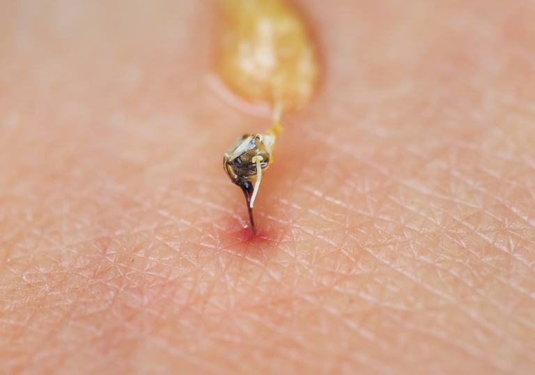 How Do You Treat An Insect Sting While Camping? How Do You Treat An Insect Sting While Camping?