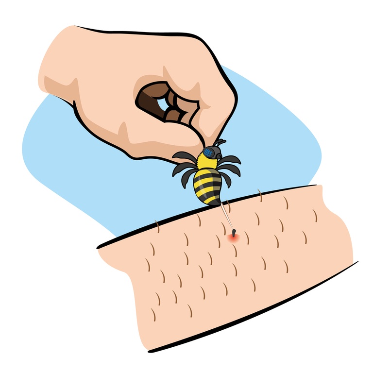 How Do You Treat An Insect Sting While Camping? How Do You Treat An Insect Sting While Camping?