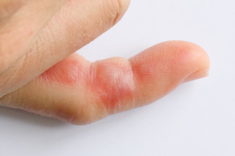 How Do You Treat An Insect Sting While Camping? How Do You Treat An Insect Sting While Camping?