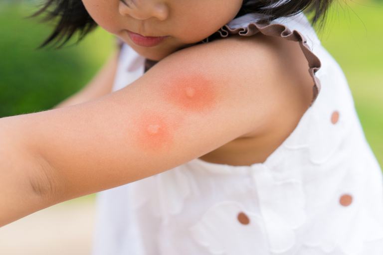 How Do You Treat An Insect Sting While Camping? How Do You Treat An Insect Sting While Camping?