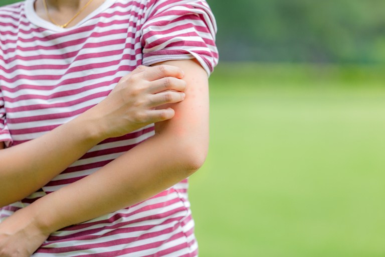 How Do You Treat An Insect Sting While Camping? How Do You Treat An Insect Sting While Camping?