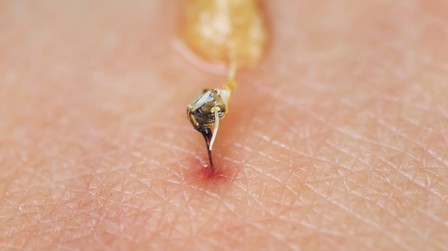 How Do You Treat An Insect Sting While Camping? How Do You Treat An Insect Sting While Camping?