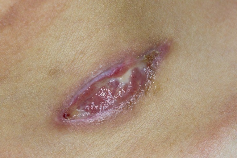 How to Treat Cuts, Scrapes, and Gouges in the Backcountry? How to Treat Cuts, Scrapes, and Gouges in the Backcountry?